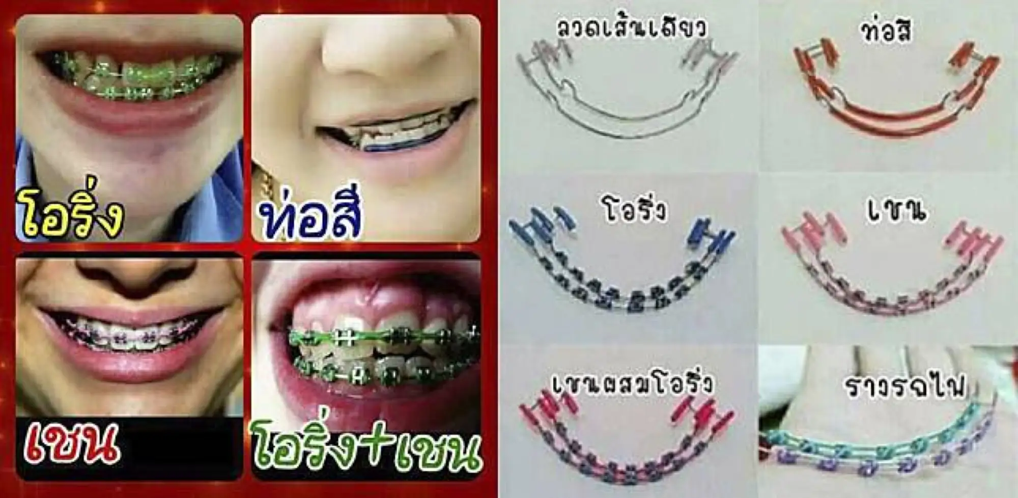 在泰国，牙套却俨然成为了一种时尚配件（图片来源：today.line.me）