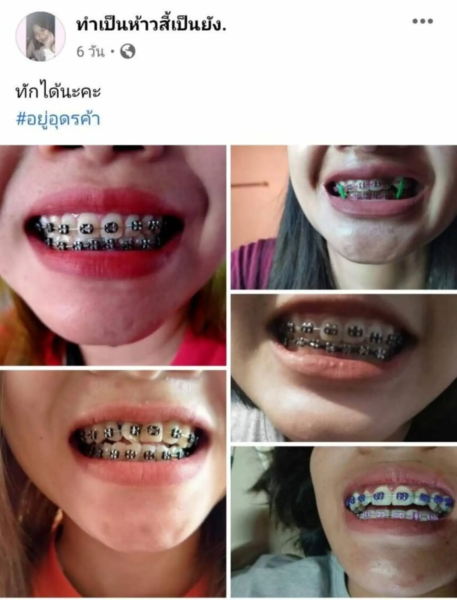 在泰國街頭，隨處可見販售牙套的商店，像在商場挑選各種衣服、飾品一樣（圖片來源：matichon.co.th）